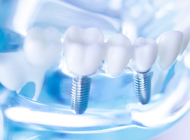 Zahnimplantate in Paderborn bei Ihrem Zahnarzt: für feste Zähne